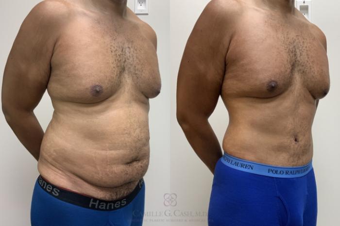 Before & After Body Lift Case 695 Right Oblique View in Houston, TX