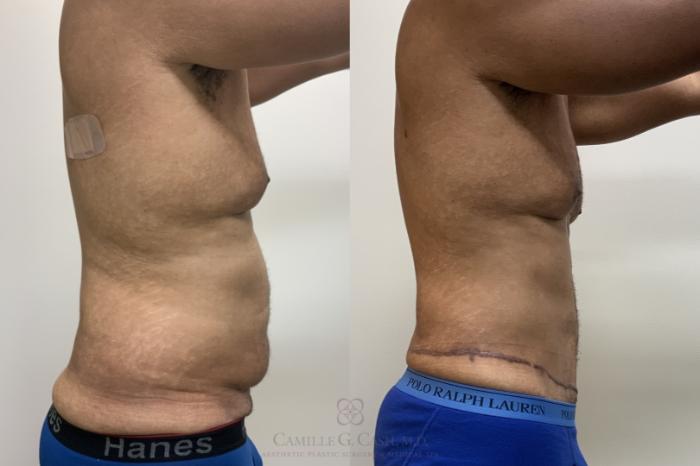 Before & After Tummy Tuck Case 695 Right Side View in Houston, TX