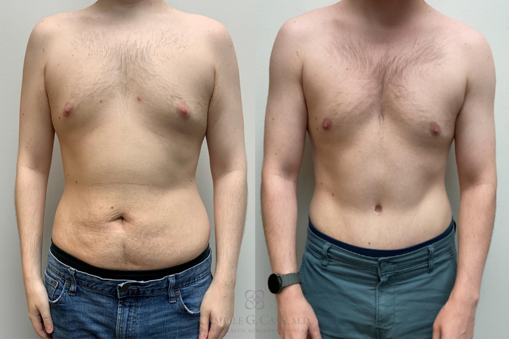 Before & After Body Contouring for Men Case 715 Front View in Houston, TX