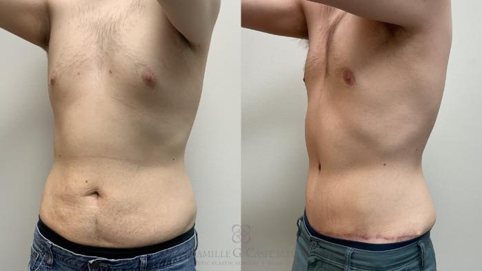 Before & After Body Contouring for Men Case 715 Left Oblique View in Houston, TX