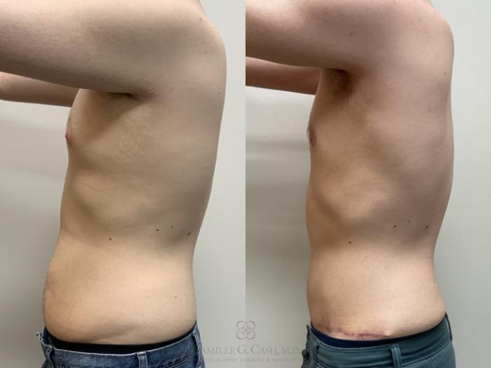 Before & After Body Contouring for Men Case 715 Left Side View in Houston, TX