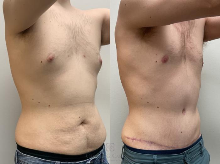 Before & After Body Contouring for Men Case 715 Right Oblique View in Houston, TX