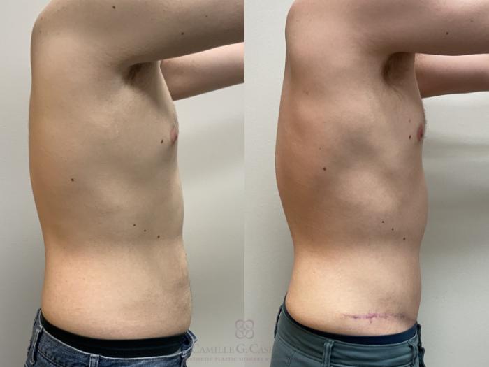 Before & After Body Contouring for Men Case 715 Right Side View in Houston, TX