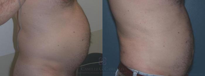 Before & After Body Contouring for Men Case 8 View #1 View in Houston, TX