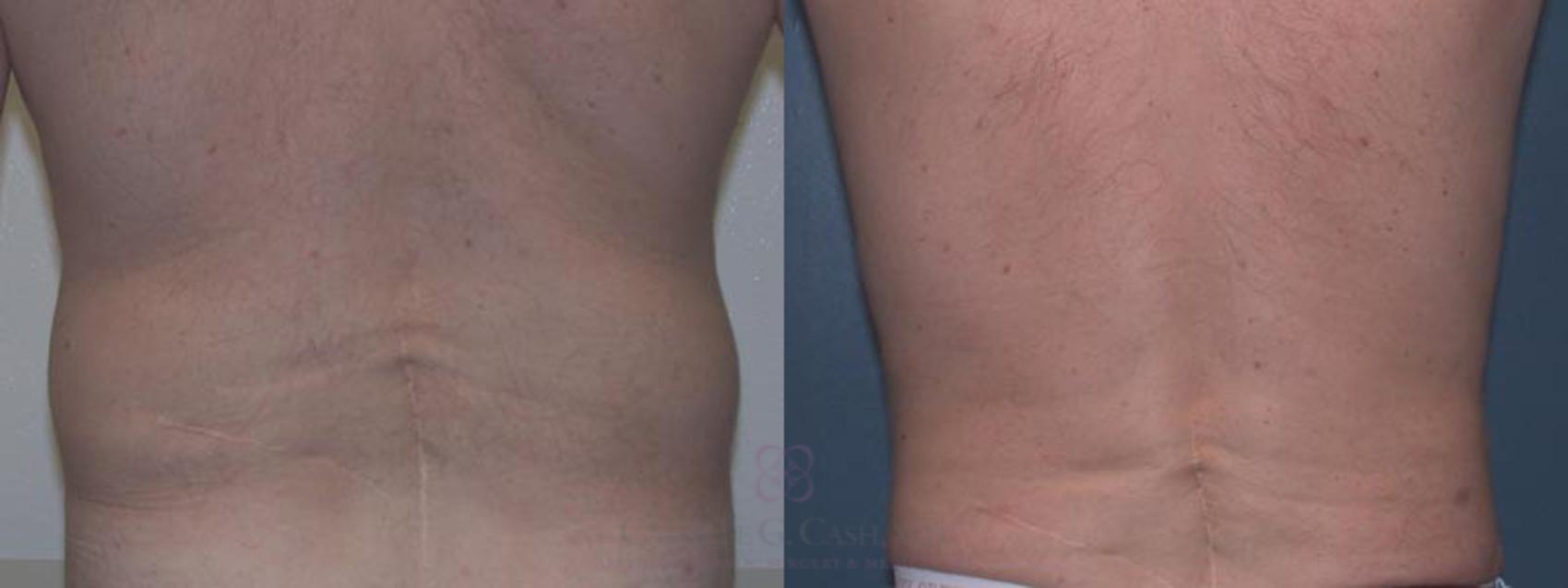 Before & After Body Contouring for Men Case 8 View #2 View in Houston, TX