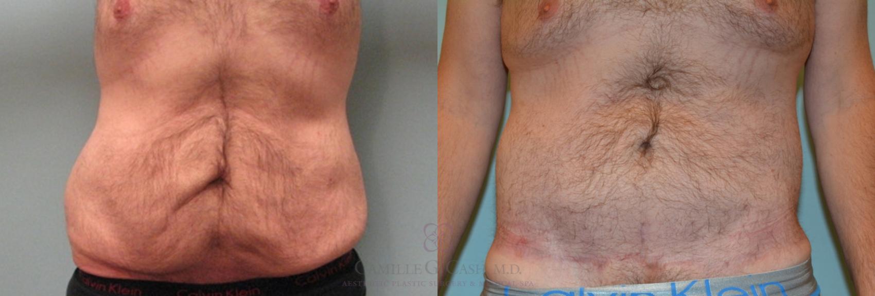Before & After Body Lift Case 157 View #3 View in Houston, TX