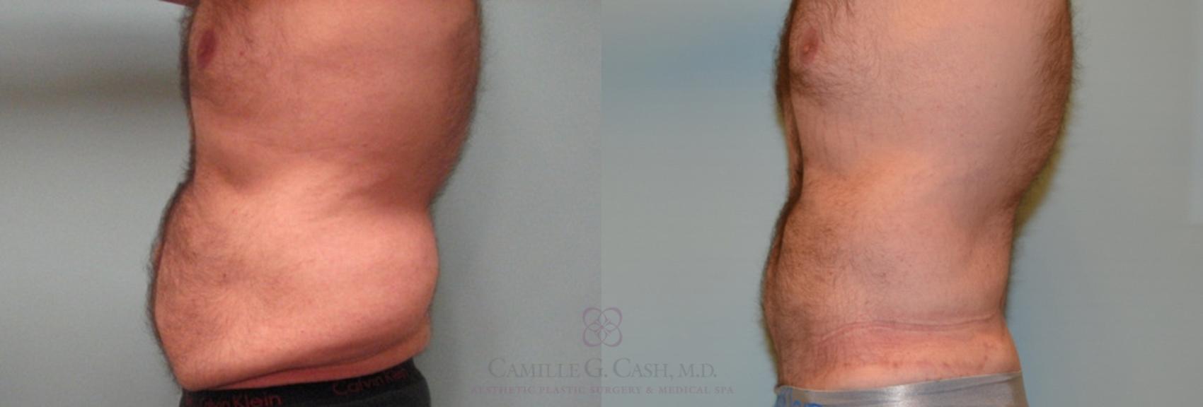 Before & After Body Lift Case 157 View #4 View in Houston, TX
