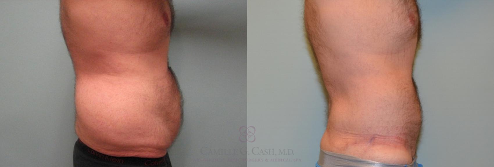 Before & After Body Lift Case 157 View #5 View in Houston, TX