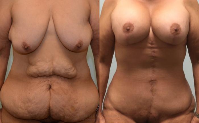 Before & After Body Lift Case 180 View #1 View in Houston, TX