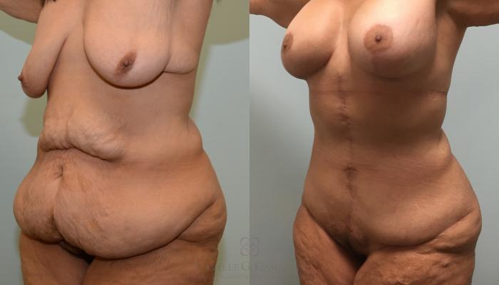 Before & After Body Lift Case 180 View #2 View in Houston, TX