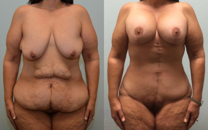 Before & After Body Lift Case 180 View #3 View in Houston, TX