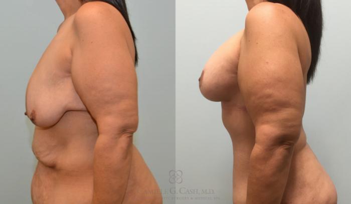 Before & After Body Lift Case 180 View #4 View in Houston, TX