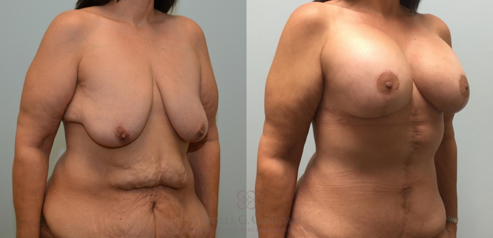Before & After Body Lift Case 180 View #5 View in Houston, TX