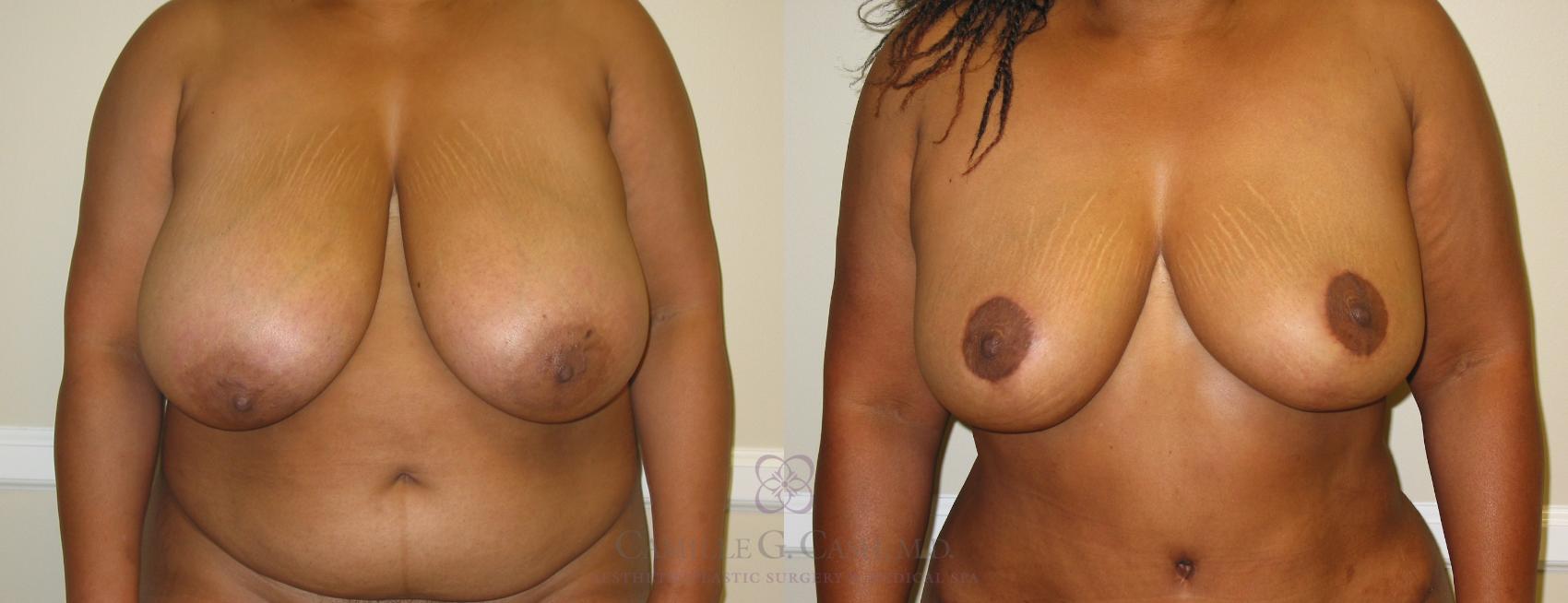 Before & After Body Lift Case 197 View #1 View in Houston, TX