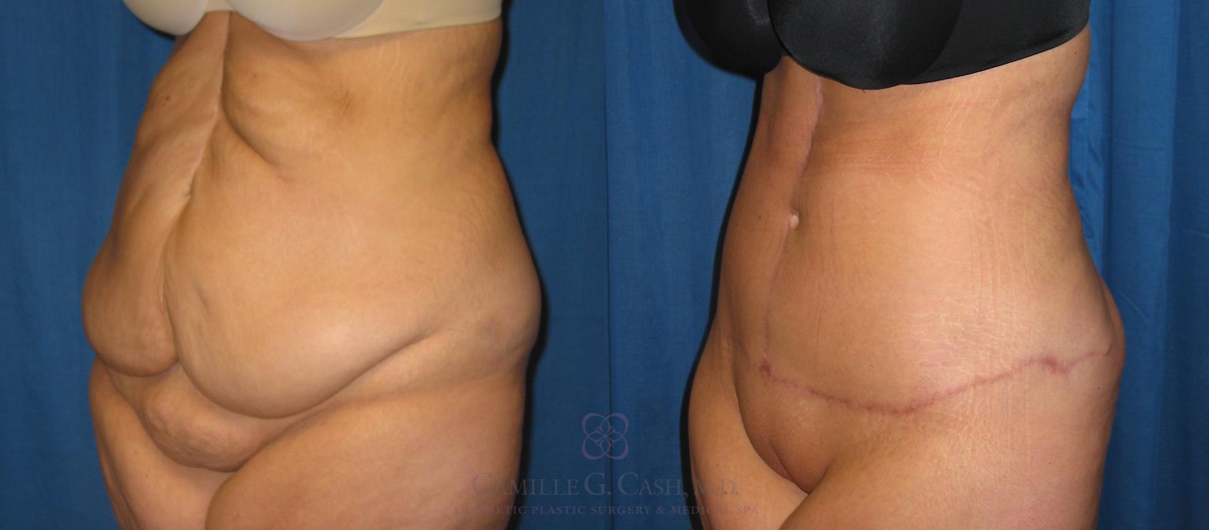 Before & After Body Lift Case 198 View #2 View in Houston, TX