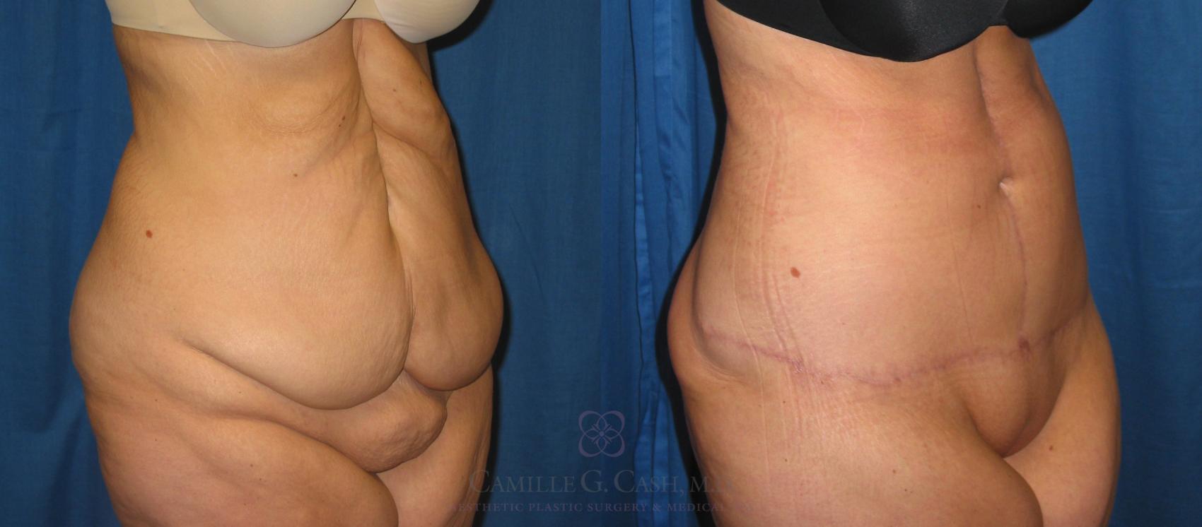 Before & After Body Lift Case 198 View #3 View in Houston, TX