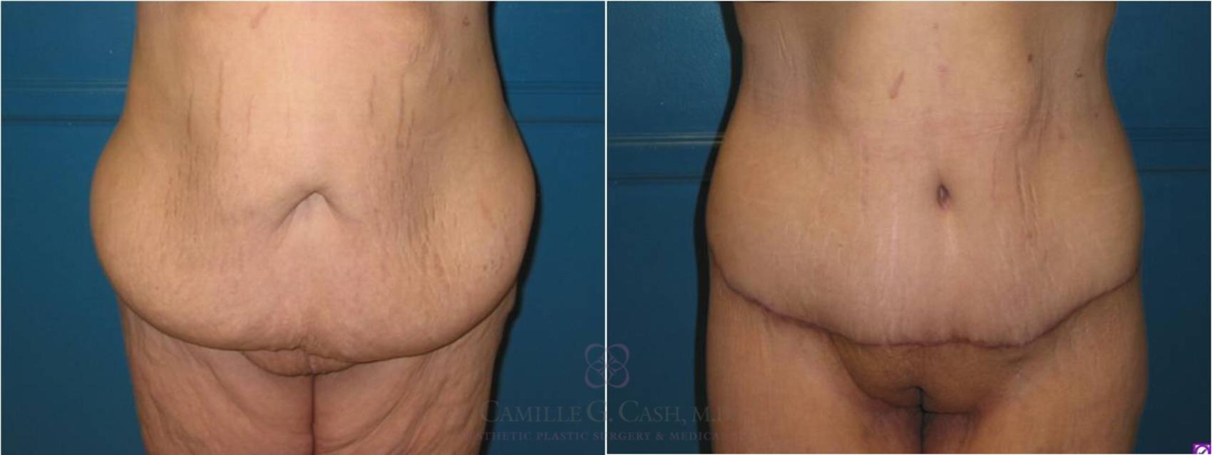 Before & After Body Lift Case 20 View #1 View in Houston, TX