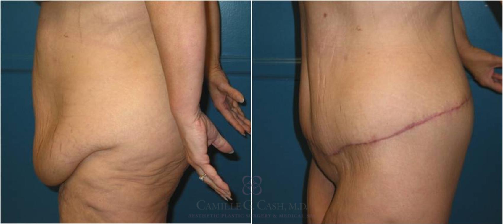 Before & After Body Lift Case 20 View #2 View in Houston, TX