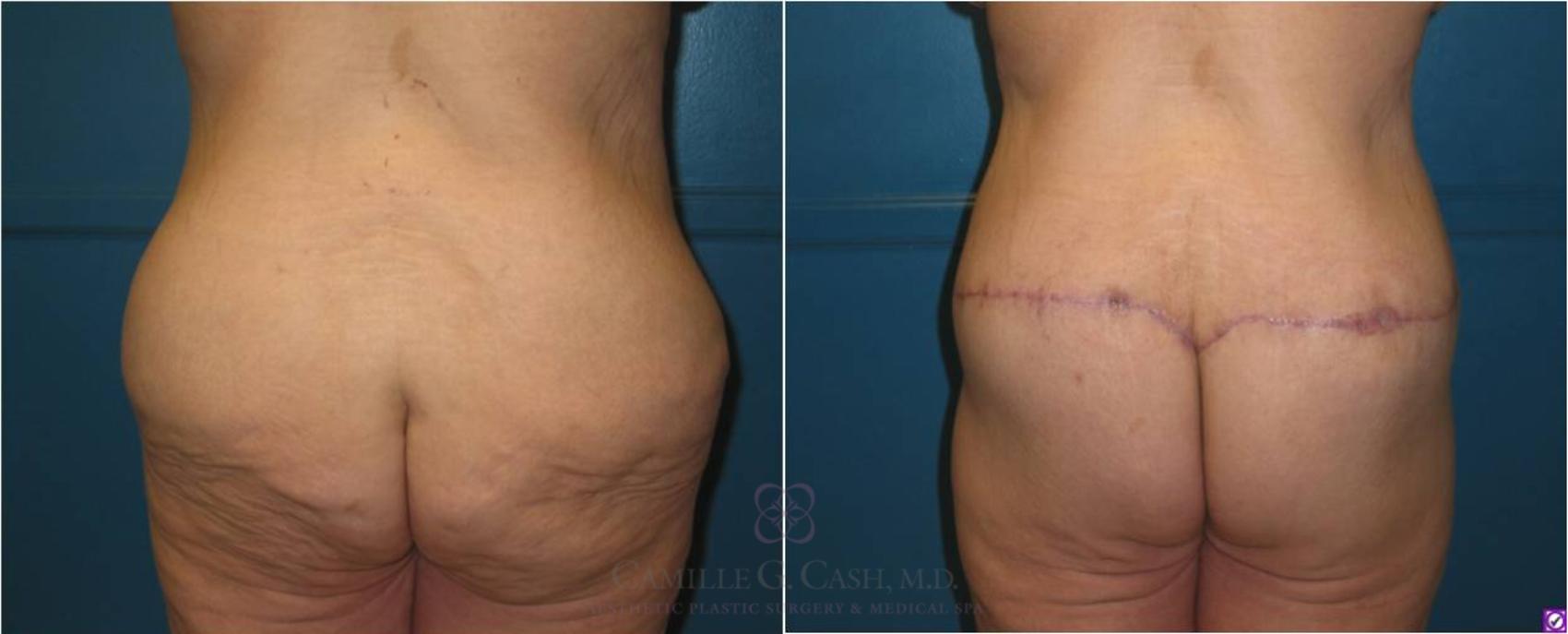Before & After Body Lift Case 20 View #3 View in Houston, TX