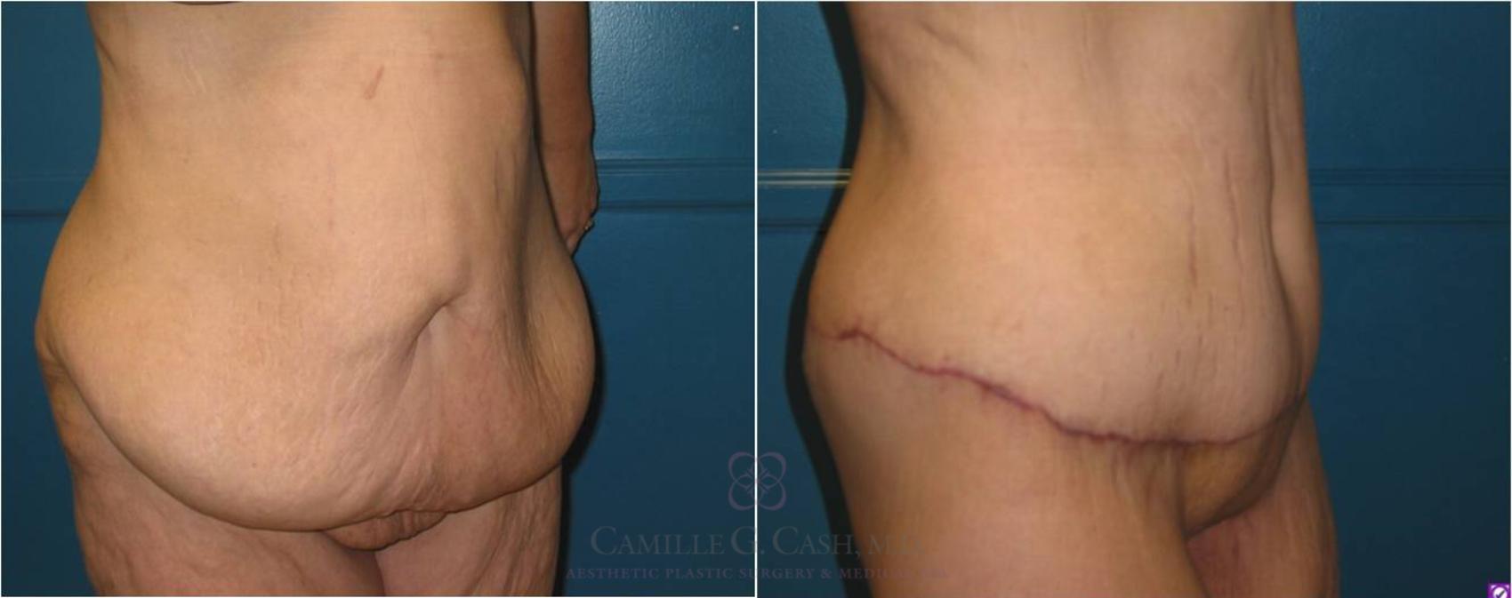 Before & After Body Lift Case 20 View #4 View in Houston, TX