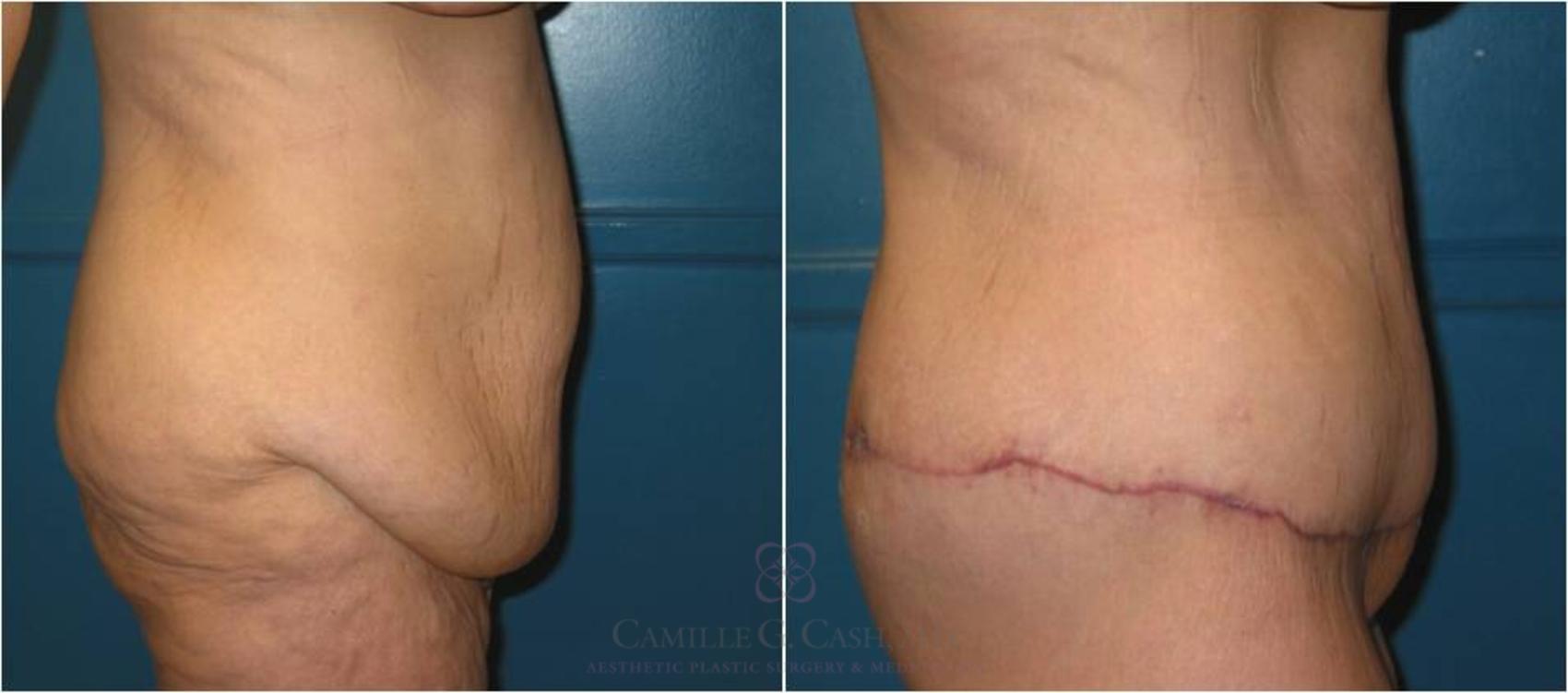 Before & After Body Lift Case 20 View #5 View in Houston, TX