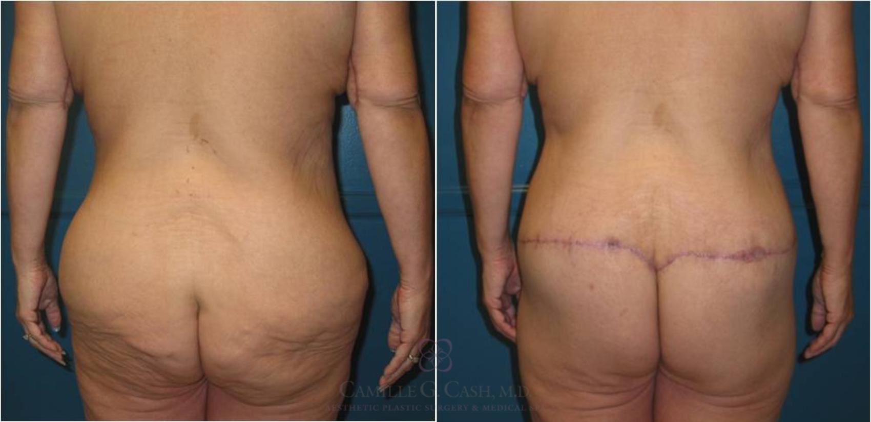 Before & After Body Lift Case 20 View #6 View in Houston, TX