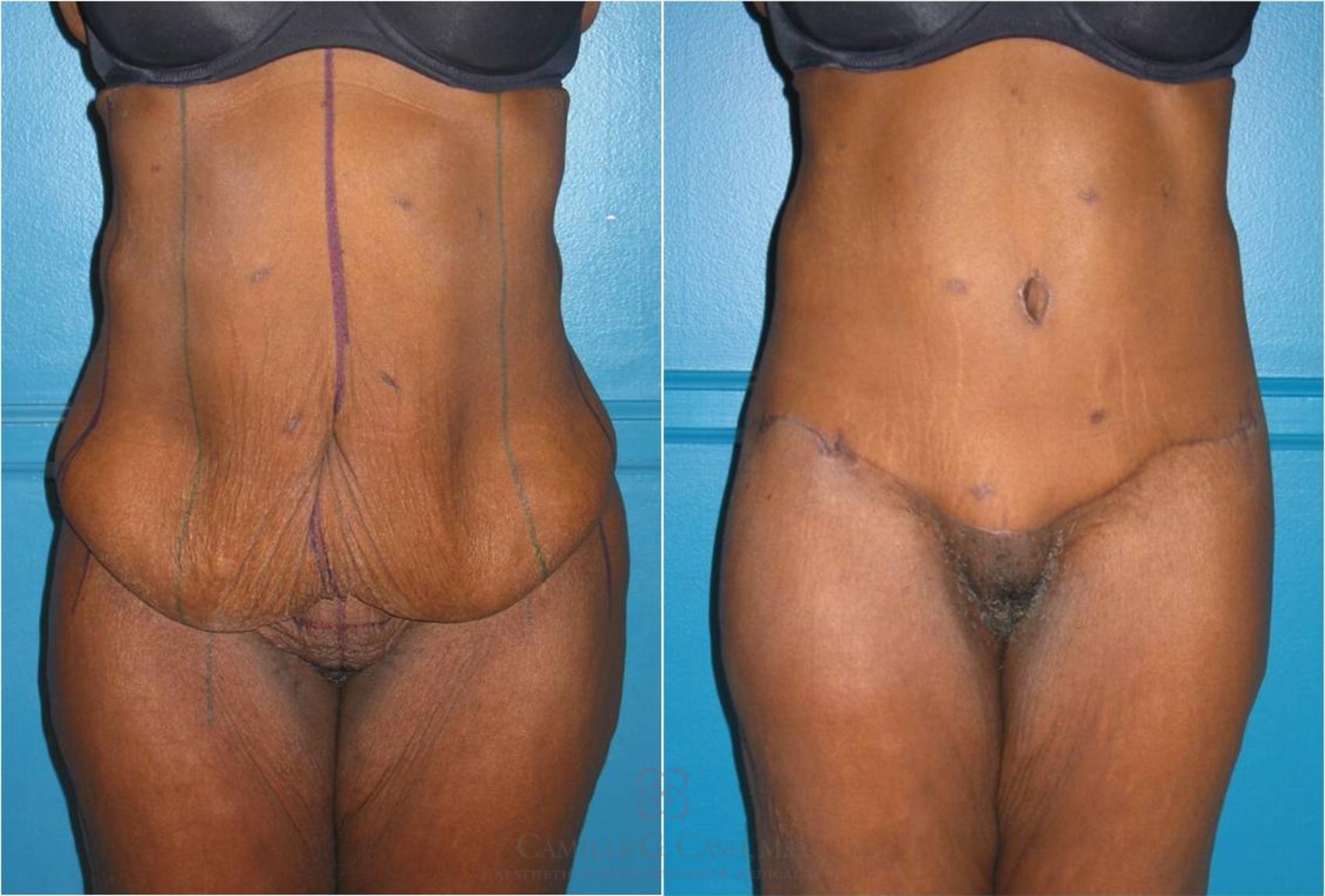Before & After Body Lift Case 31 View #1 View in Houston, TX