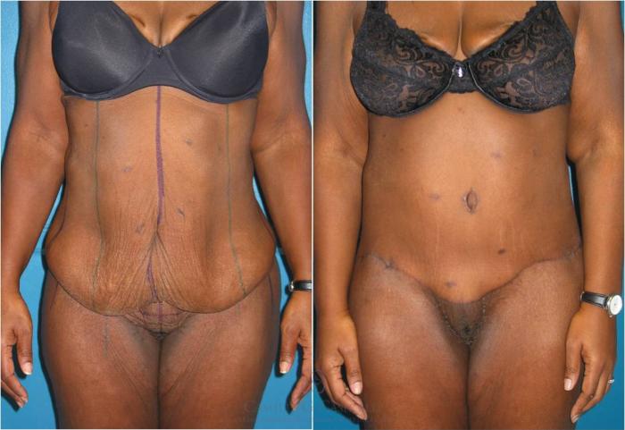Before & After Body Lift Case 31 View #2 View in Houston, TX
