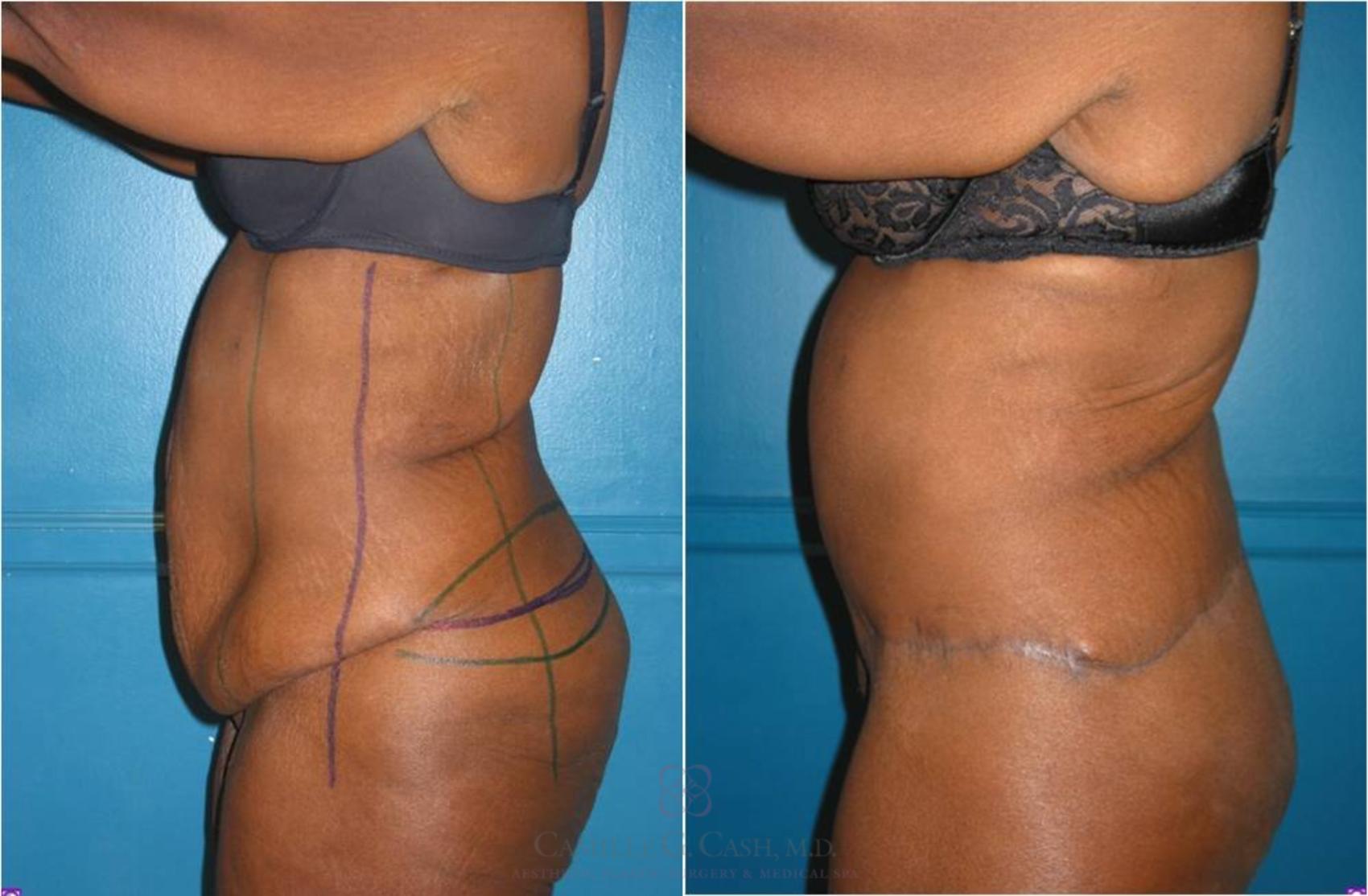 Before & After Body Lift Case 31 View #3 View in Houston, TX