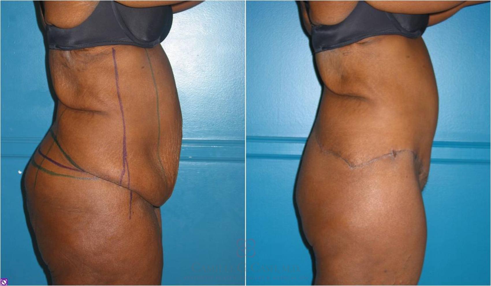 Before & After Body Lift Case 31 View #4 View in Houston, TX