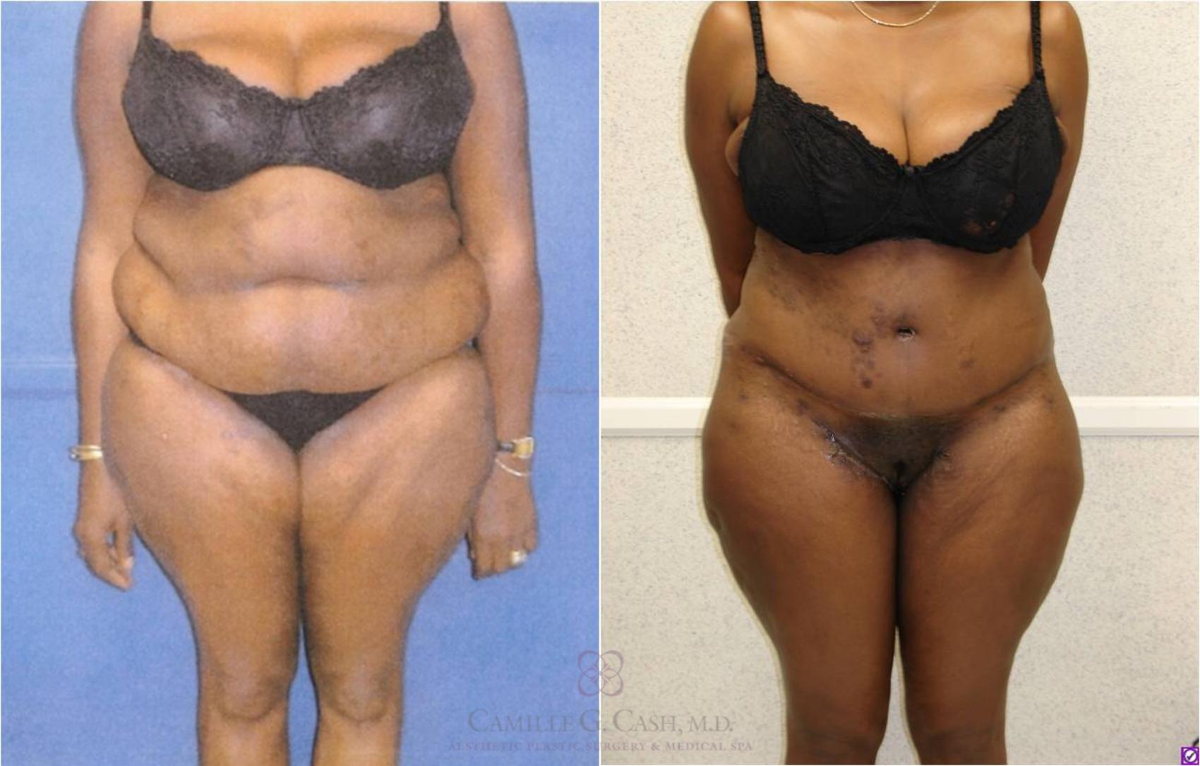 Before & After Body Lift Case 32 View #1 View in Houston, TX