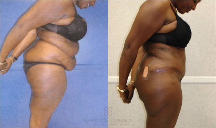Before & After Body Lift Case 32 View #10 View in Houston, TX