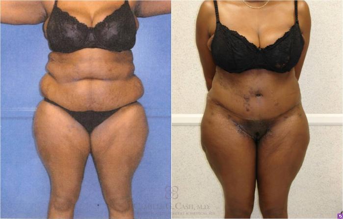 Before & After Body Lift Case 32 View #2 View in Houston, TX