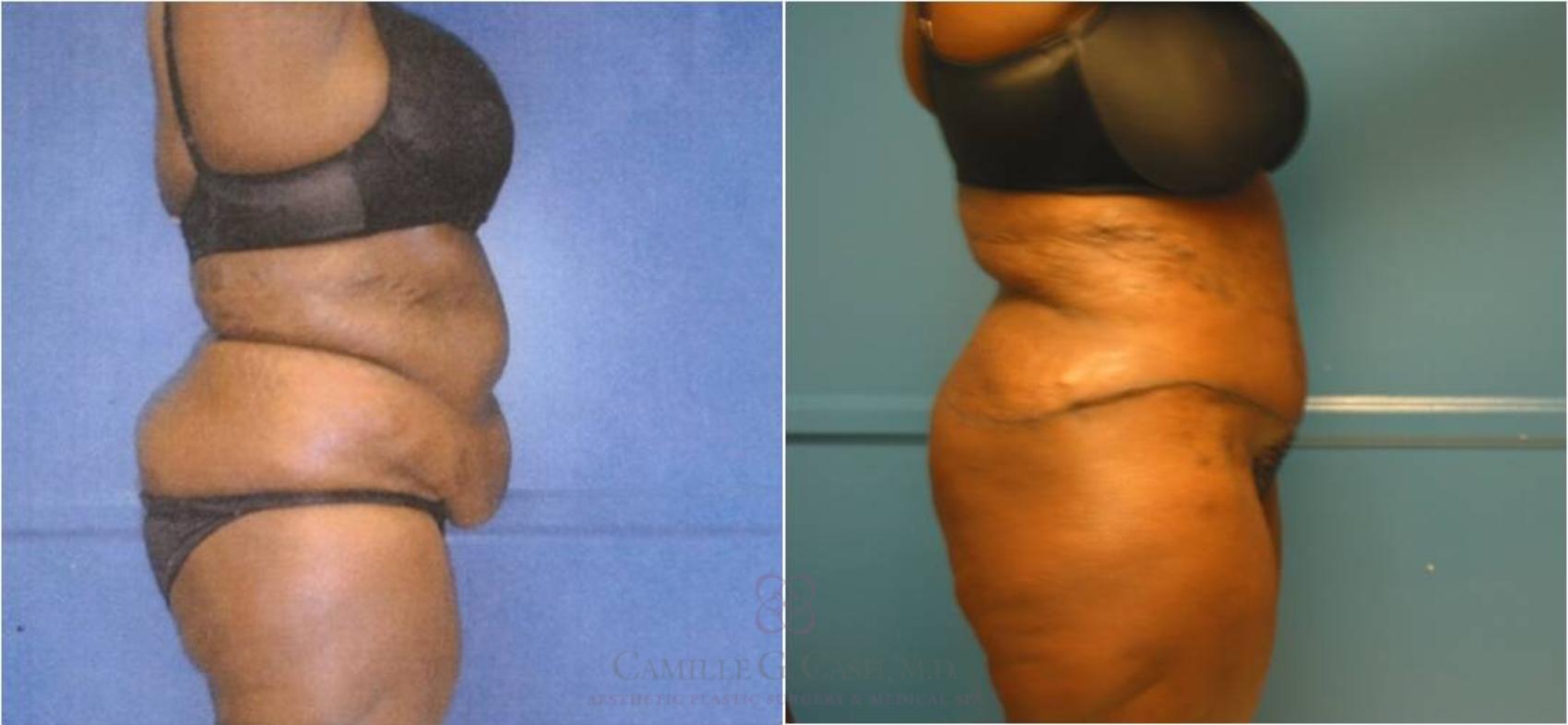 Before & After Body Lift Case 32 View #4 View in Houston, TX