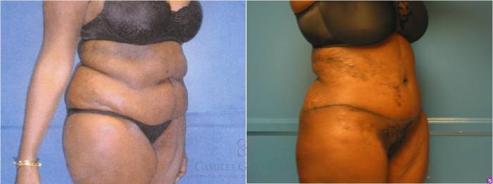 Before & After Body Lift Case 32 View #5 View in Houston, TX