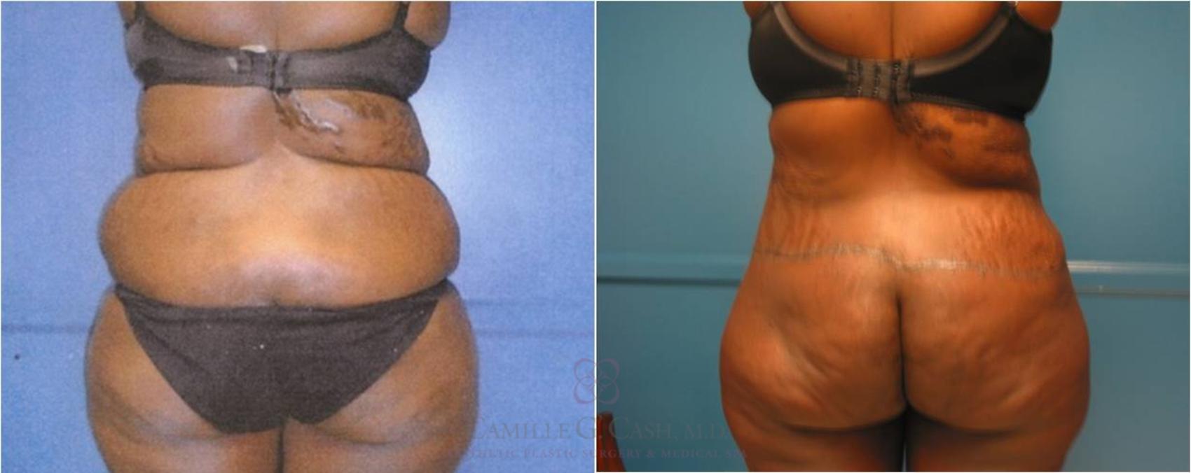 Before & After Body Lift Case 32 View #6 View in Houston, TX