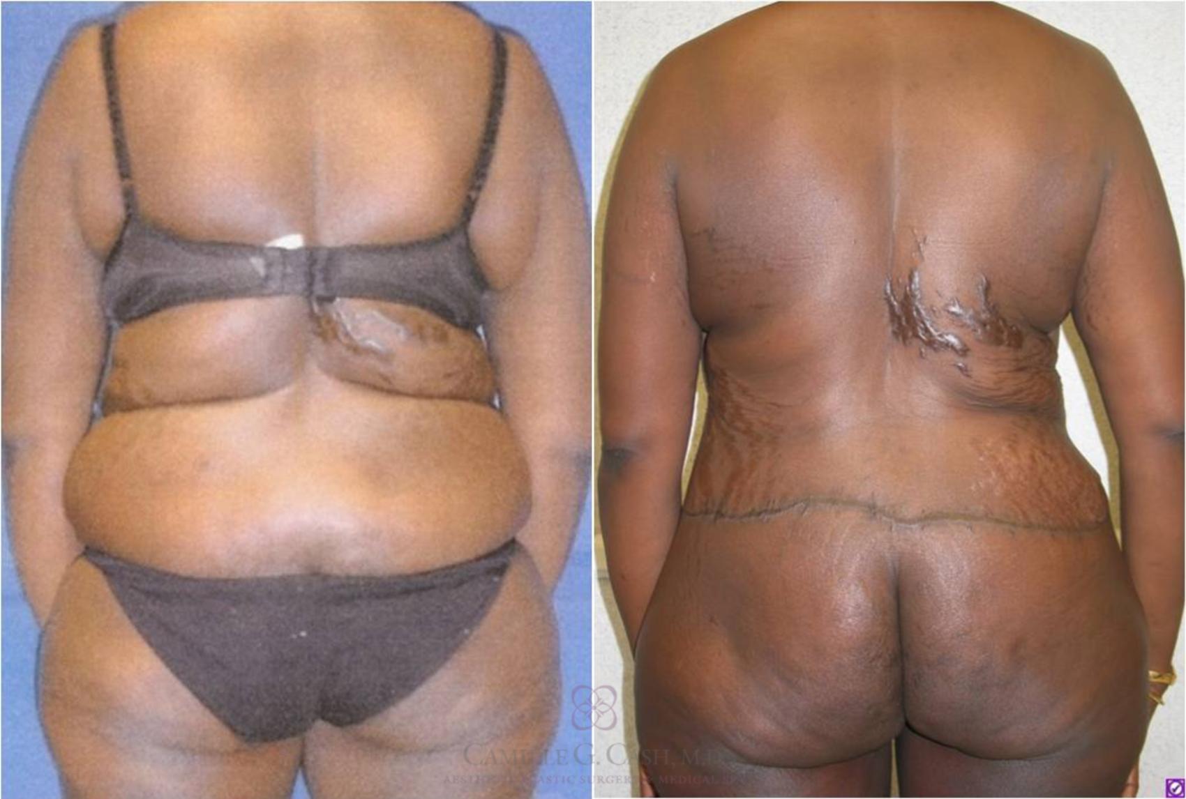 Before & After Body Lift Case 32 View #7 View in Houston, TX