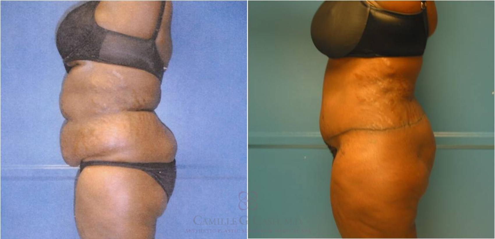Before & After Body Lift Case 32 View #8 View in Houston, TX