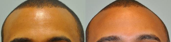 Before & After BOTOX® Cosmetic Case 106 View #1 View in Houston, TX