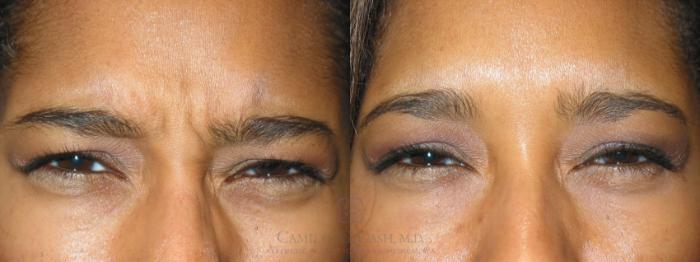 Before & After BOTOX® Cosmetic Case 141 View #1 View in Houston, TX