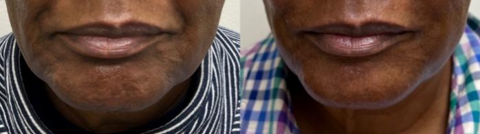 Before & After BOTOX® Cosmetic Case 483 front bottom View in Houston, TX