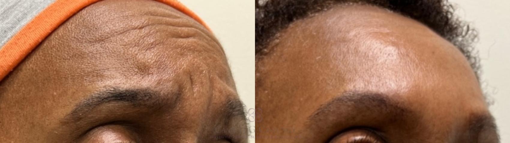 Before & After BOTOX® Cosmetic Case 483 oblique 2 View in Houston, TX