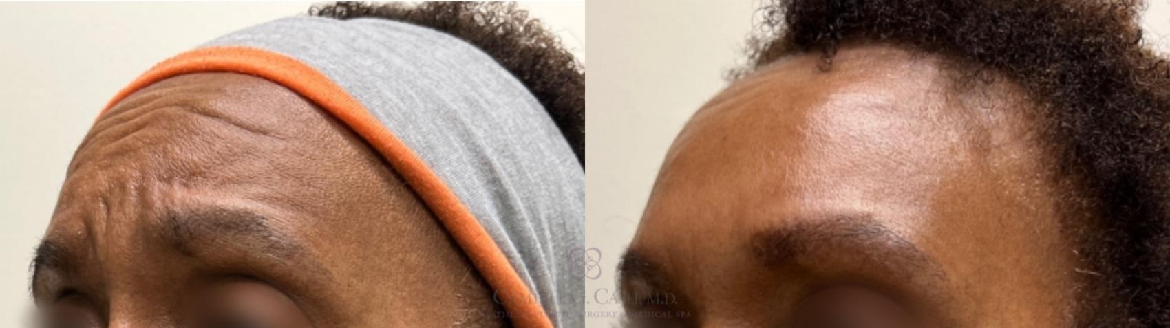 Before & After BOTOX® Cosmetic Case 483 oblique b View in Houston, TX