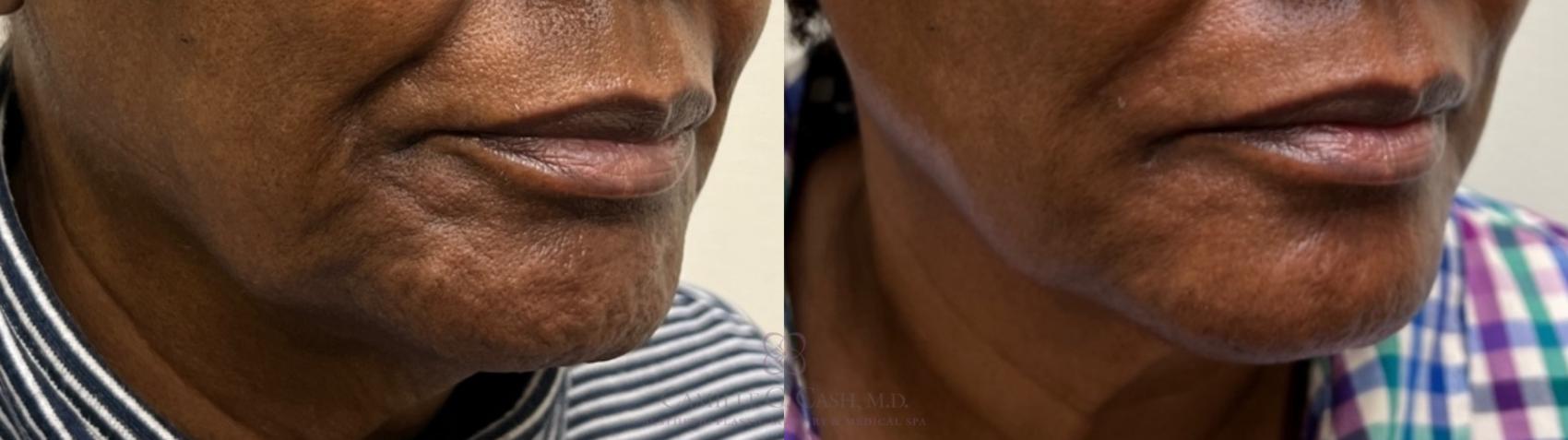 Before & After BOTOX® Cosmetic Case 483 Right Oblique View in Houston, TX