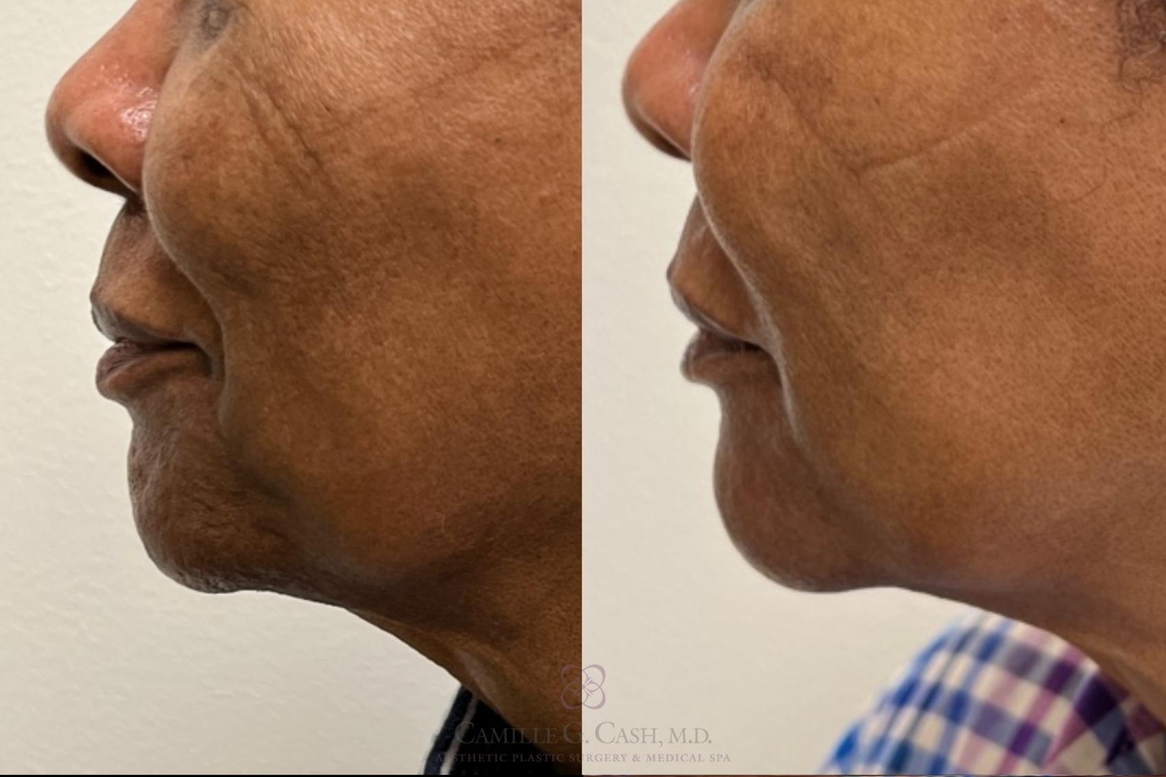 Before & After BOTOX® Cosmetic Case 483 Right Side View in Houston, TX