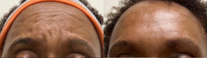 Before & After BOTOX® Cosmetic Case 483 top front View in Houston, TX