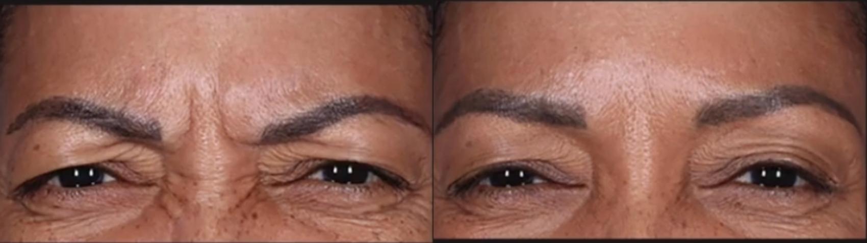 Before & After BOTOX® Cosmetic Case 572 before and 6 months after View in Houston, TX