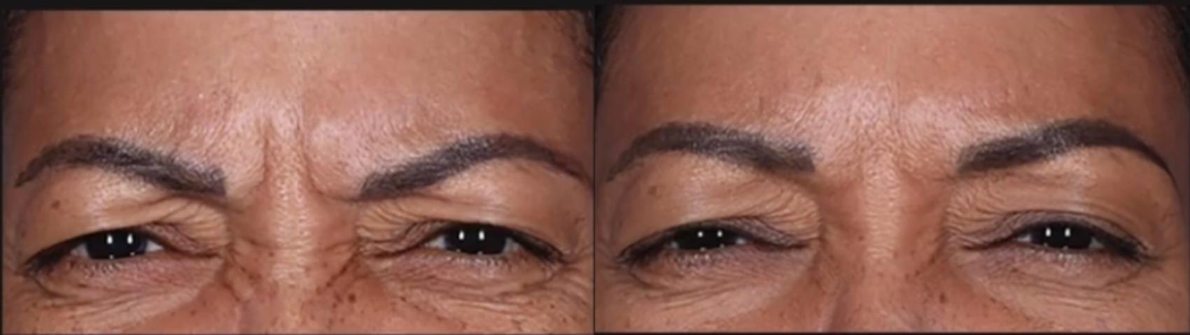 Before & After BOTOX® Cosmetic Case 572 before and 9 months after View in Houston, TX