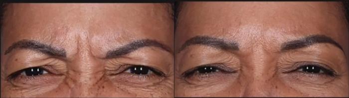 Before & After BOTOX® Cosmetic Case 572 before and 9 months after View in Houston, TX