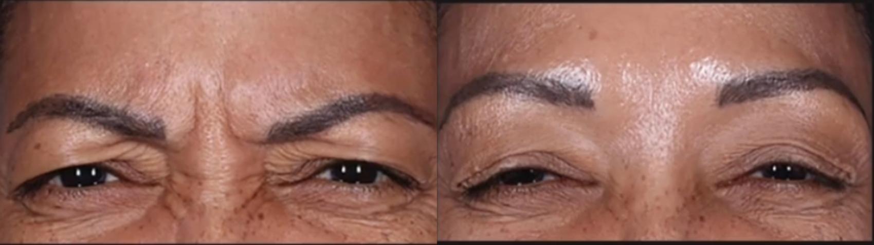 Before & After BOTOX® Cosmetic Case 572 Front View in Houston, TX